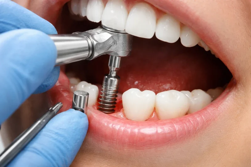 รากฟันเทียมราคาเท่าไหร่และควรรู้อะไรบ้างก่อนตัดสินใจ